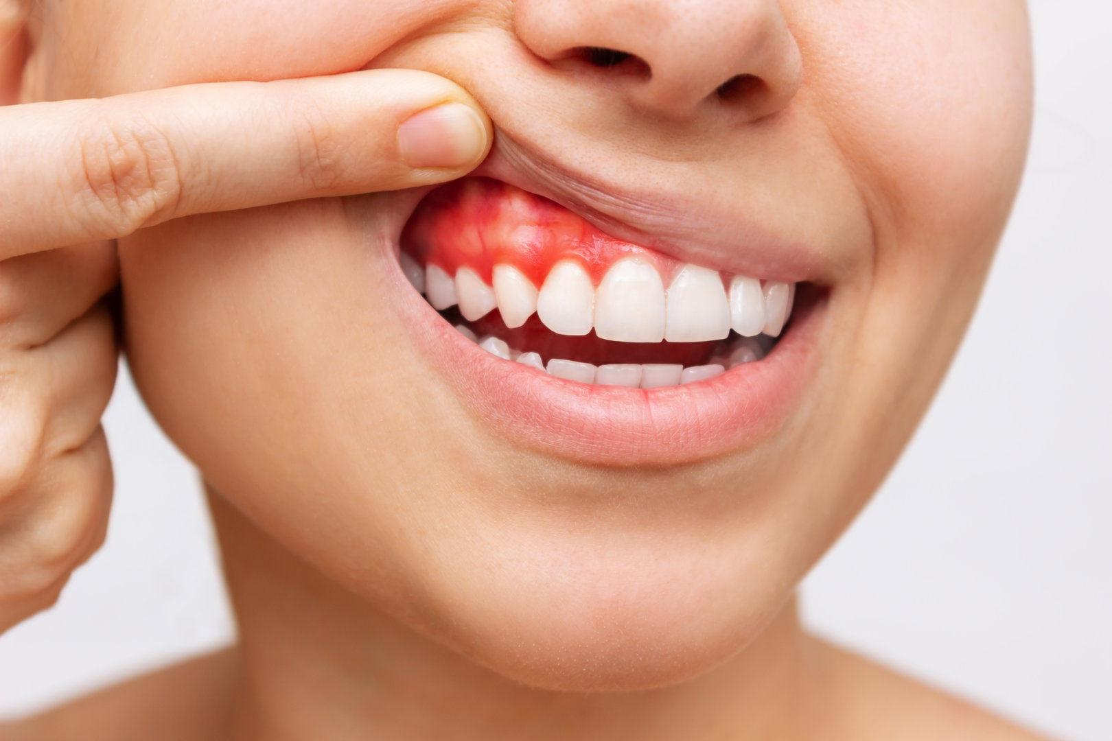 gum-disease3