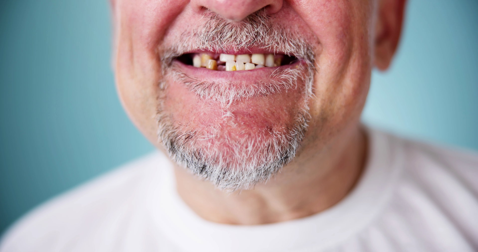 Dental Implants For Missing Teeth