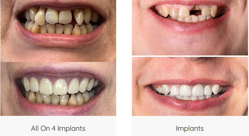 Implants Dentist in Seattle